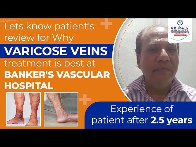 Best treatment centre for varicose vein in India …Bankers Vascular Hospital