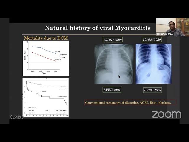 IAPTCB Webinar - Management of CHF - Dr Nageswar Rao