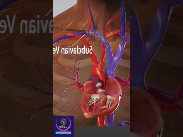 Pacemaker Insertion Procedure - Cardiac Treatment