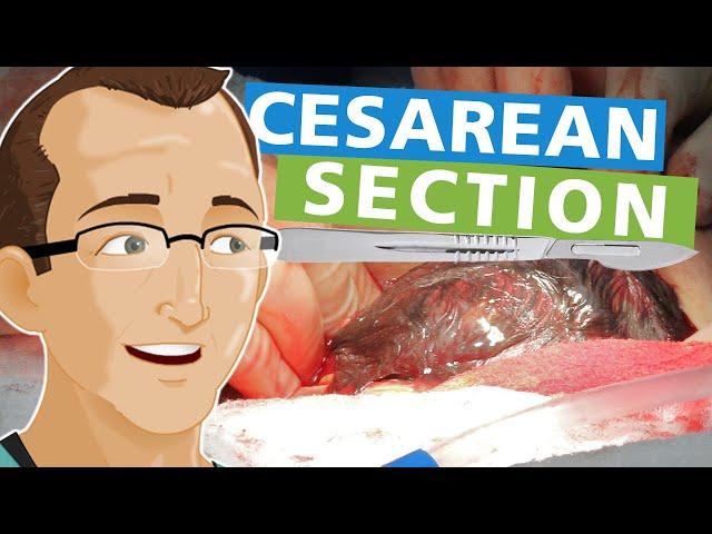 Cesarean Section