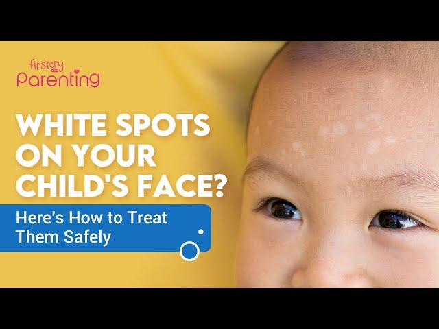 White Patches Or Spots On Child's Face - Causes and Treatments