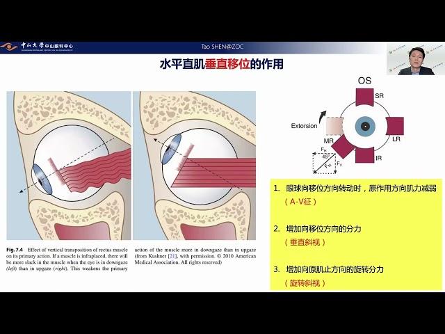 演讲：共同性斜视合并的“非共同性”问题——水平直肌肌肉止端移位手术