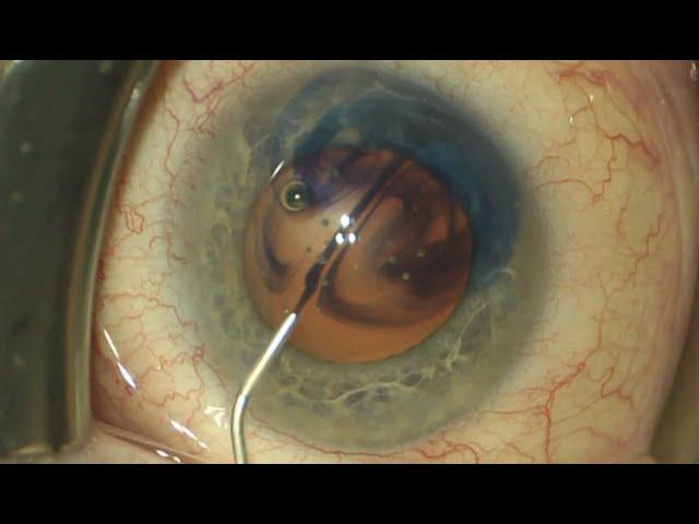 Cataract Extraction + Canaloplasty in Setting of Long Anterior Zonules  (Malik Y. Kahook, MD)