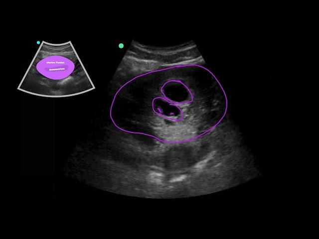 POCUS: 1st Trimester Pregnancy Case 3 - Twin Gestation 6w5d