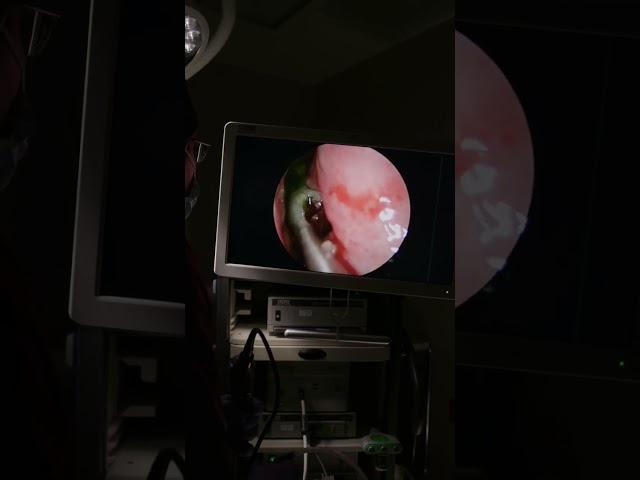 Removing a Sinus fungus ball from a patient’s nose! #nose #allergy #allergies #snot