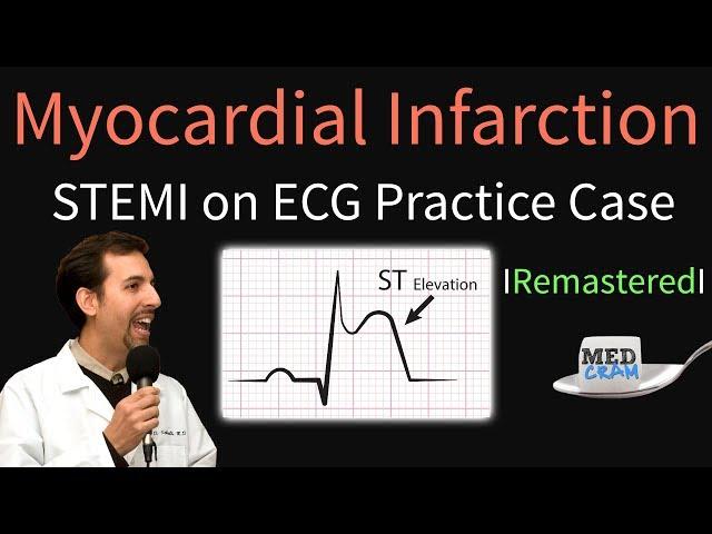 Myocardial Infarction / STEMI on ECG - Practice EKG