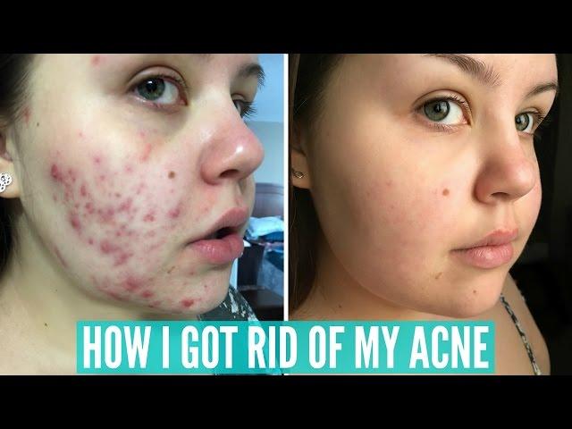 HOW I CLEARED UP MY SEVERE ACNE | SariReanna