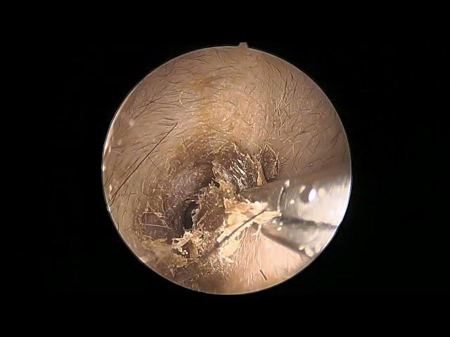 Ear wax removal