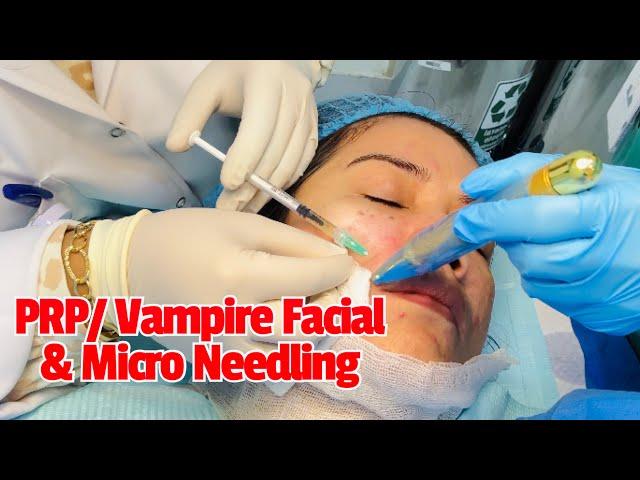 My first PRP/Vampire Facial & Micro Needling Experience for Face Rejuvenation I The Rhonzie Vlog