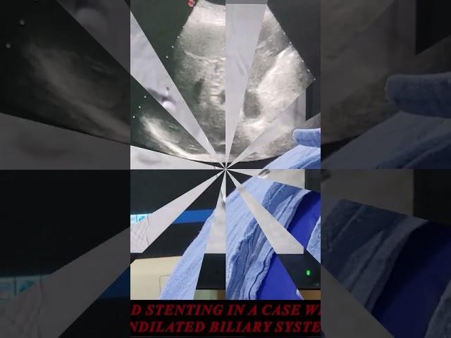 #SHORTS# PTBD STENTING IN A CASE WITH  UNDILATED #IR FACILITIES TREATMENT