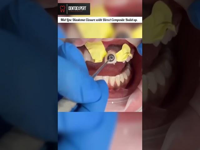 Mid Line Diastema Closure with Direct Composite Buildup #shorts #dentist #diastema #teeth #viral 