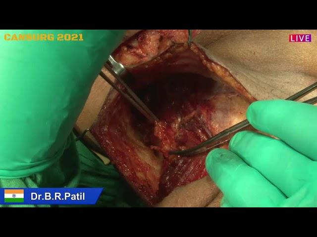 4. Hemi Mandibulectomy with Wide Excision (Ca Buccal Mucosa) - DR B R PATIL CASE 4 (Part1)