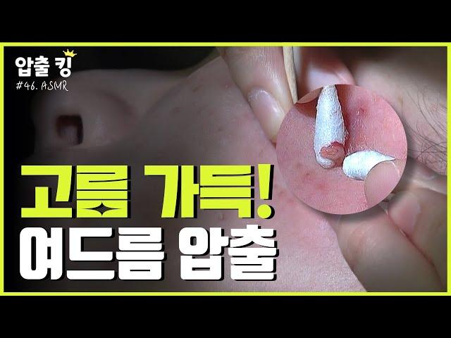 [압출킹] 46. 고름 가아~~득! 화농성 여드름 압출 ASMR 시원함 주의!!!