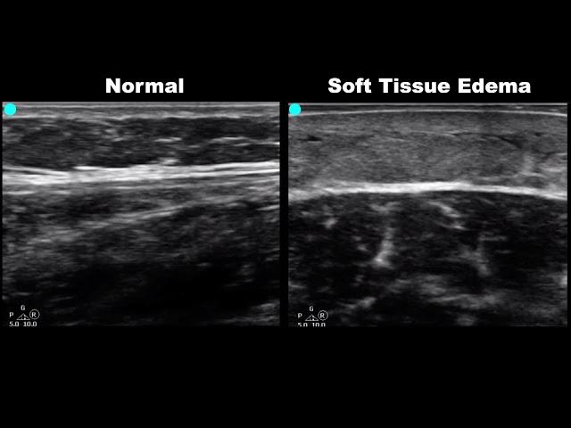 POCUS - Soft Tissue Ultrasound - Subcutaneous Air