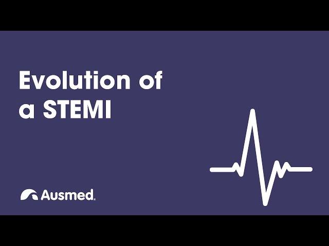 Evolution of a STEMI | Ausmed Explains...