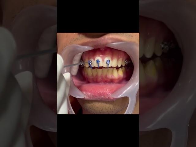 Damon Braces: Advanced Self ligating braces #braces #dentist #mydentistchandigarh #smile