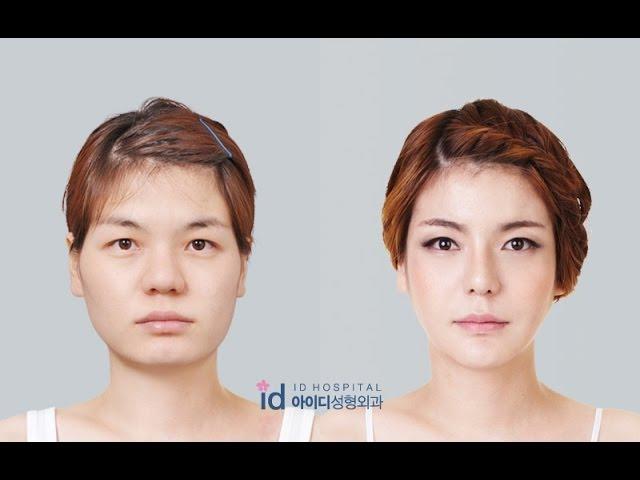 let me in korean show (jawline, rhinoplasty, cheekbone reduction) plastic surgery before and after