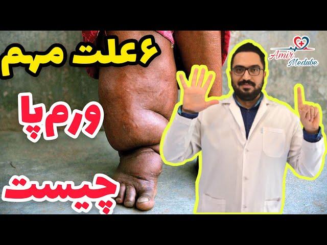 علت های مهم ورم پا (ادم پا)  چیست؟ چرا پا ها ورم میکنند؟ ایا ورم پا خطرناک است؟ درمان ورم پا چیست؟