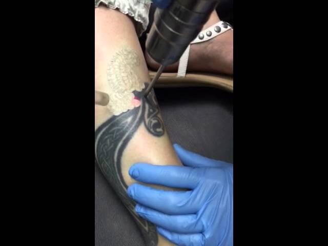 Laser Tattoo Removal Leg Seriously Skin Chagrin Falls, Ohio Dr. Jennifer Kish