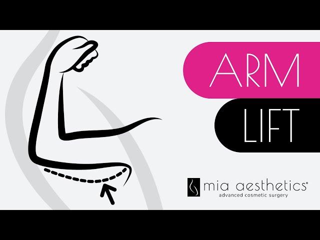 How Arm Lifts (Brachioplasty) Work By Dr. Alvarez At Mia Aesthetics