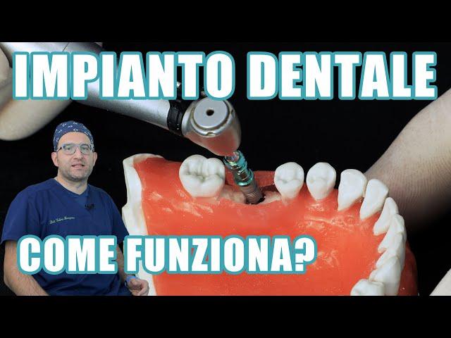 Impianto dentale fisso 1/3