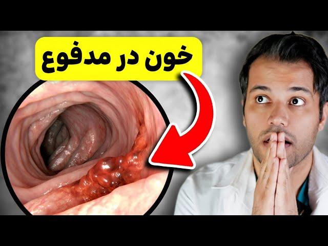 10 علامت سرطان کولون که باید بدونيد | خون در مدفوع یعنی سرطان؟!