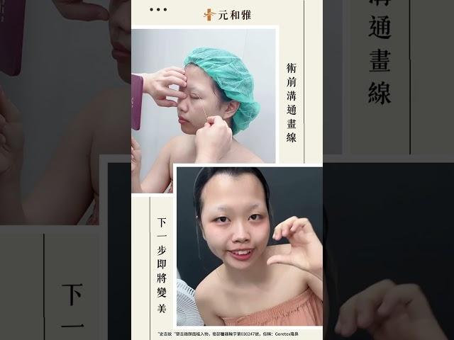 #元和雅 #隆鼻 #半肋隆鼻 #縮鼻翼 #雙眼皮 #開眼頭 煥然一新，術前術後差很多