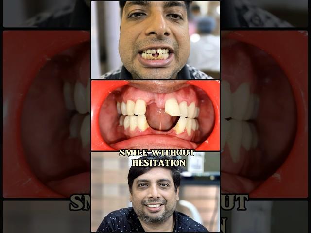 SMILE MAKEOVER FOR ANTERIOR TEETH..#smile #dental #teeth #trending #youtube #shorts