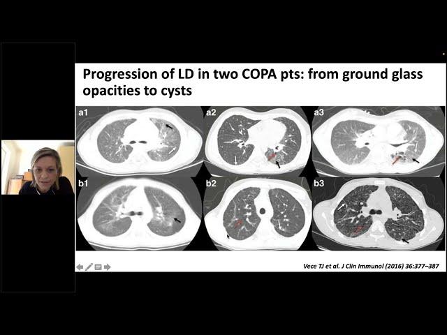 How I diagnose interstitial lung disease in different immune-mediated disorders? | Dr Bracaglia