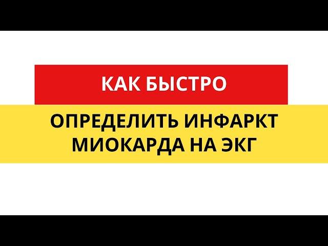 Как быстро определить инфаркт миокарда на ЭКГ?#Shorts