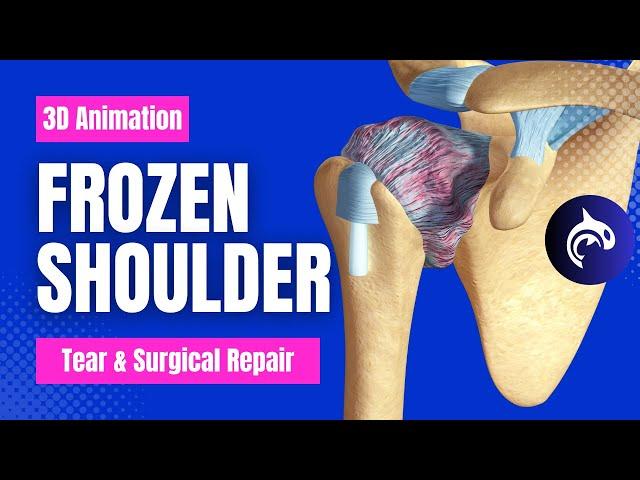 Frozen Shoulder (Adhesive Capsulitis)