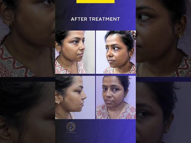 Title: Nose Correction Treatment        #cosmogene #youtubeshort #shorts #shortsyoutube#nosejob