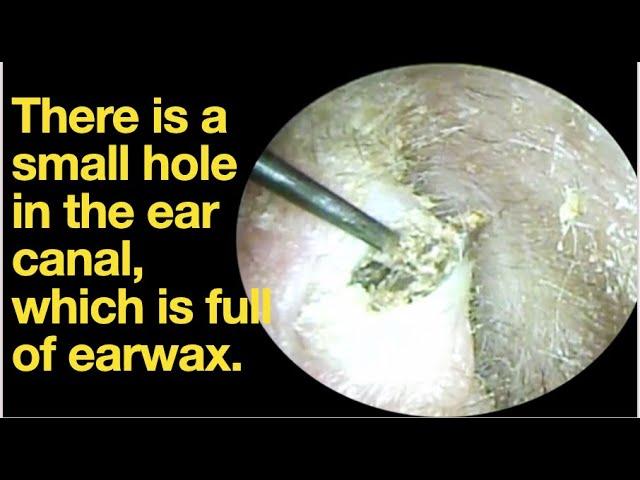 There is a small hole in the ear canal, which is full of earwax.|ear wax removal |ASMR |