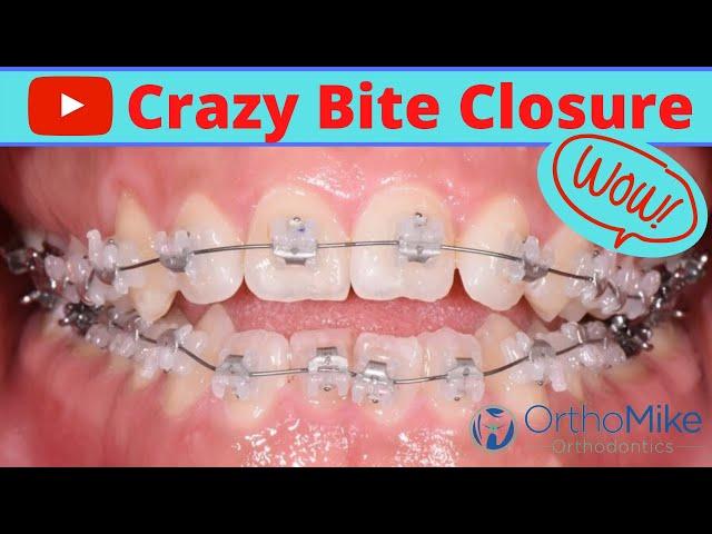 Amazing Open Bite - Before and After - Clear Braces