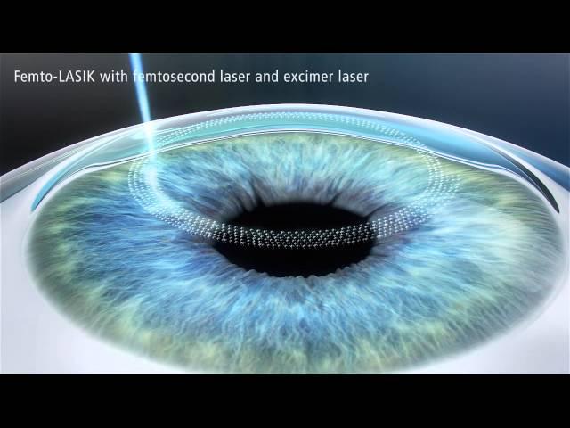 Zeiss - LASIK with femtosecond laser and excimer laser