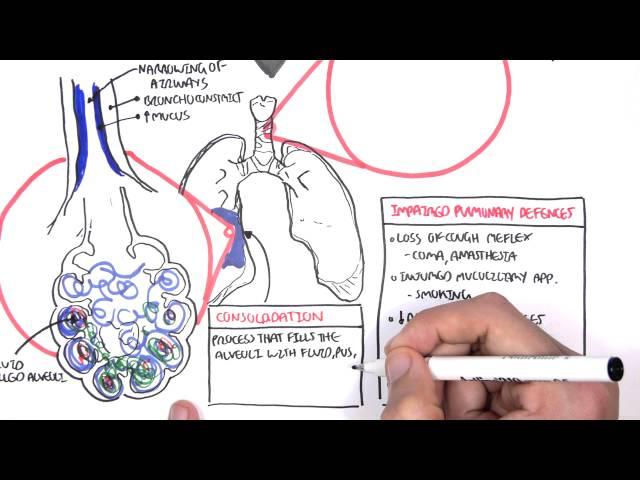 PART I - Pneumonia (Overview, Lobar and Bronchopneumonia)