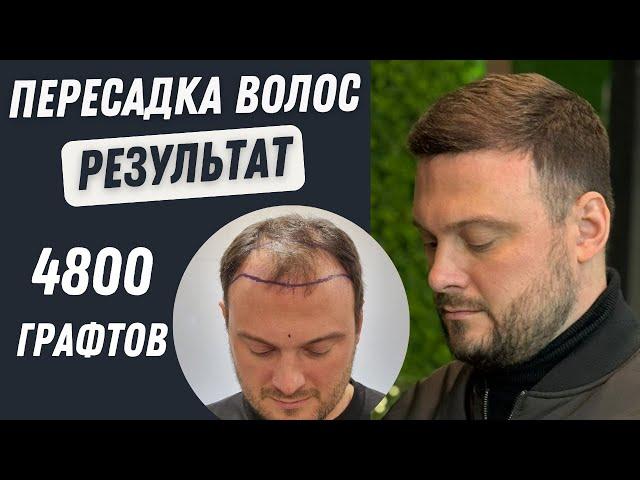 Пересадка Волос До и После 5000 графтов | Пересадка волос в Турции #пересадкаволос