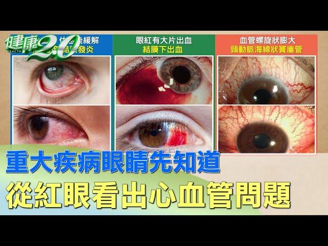 重大疾病眼睛先知道 從紅眼看出你的心血管問題 健康2.0