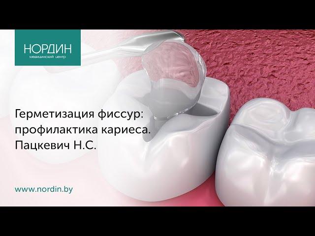 Герметизация фиссур