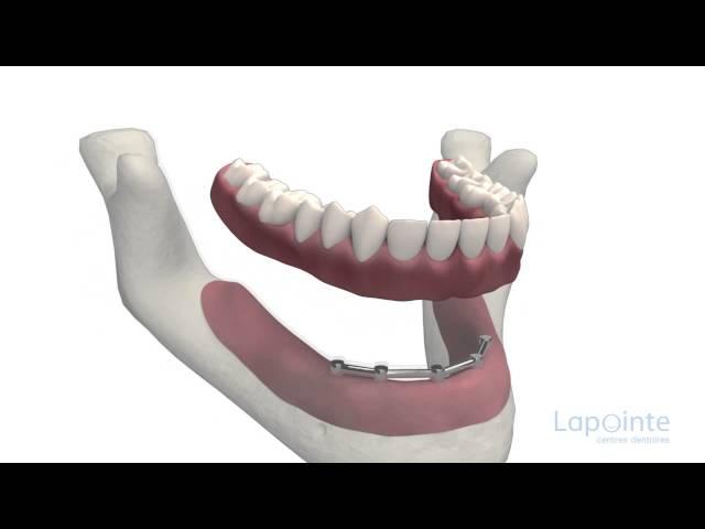 Prothèse complète sur implants - Centres dentaires Lapointe