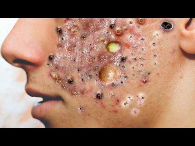 Big Cystic Acne Blackheads Extraction Blackheads & Milia, Whiteheads Removal Pimple Popping # 1065