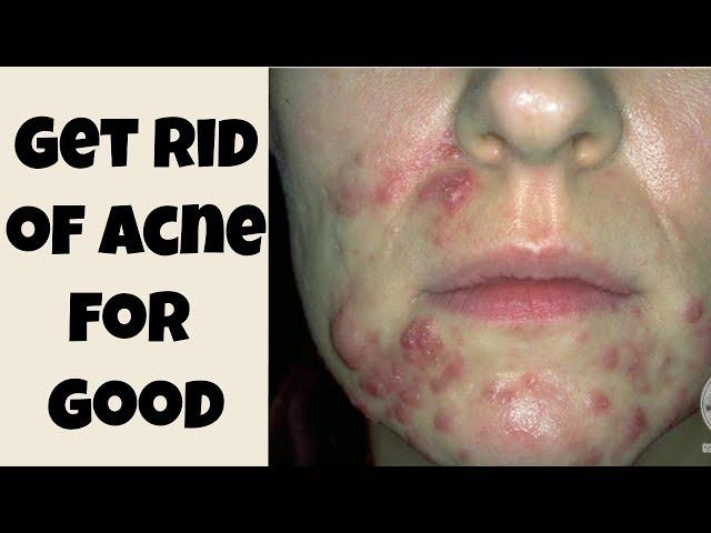 How To Get Rid of Acne (& Scars) For Good & Keep It Away  Step By Step Guide