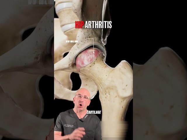Shocking Look At Hip Arthritis Damage⁉️