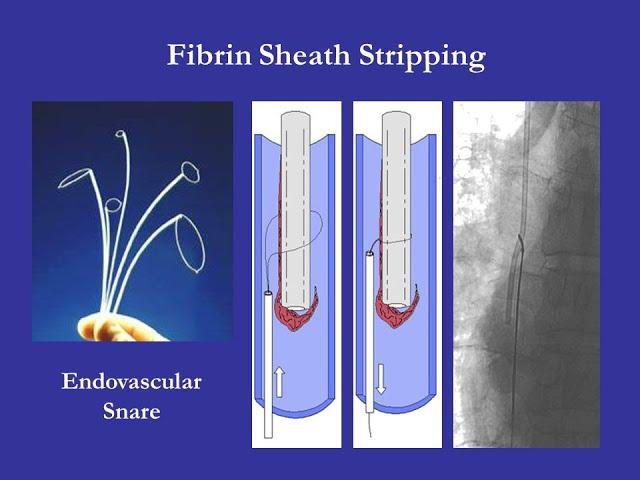 Fibrin Sheath Stripping | stripping of fibrin sheath from perm cath tip in hyderabad by Dr Shailesh