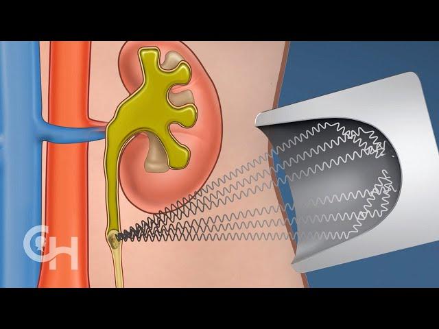 Shockwave Lithotripsy Surgery for Kidney Stones in Children