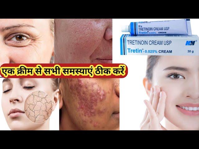 Tretinoin cream | How to remove pimple  overnight |