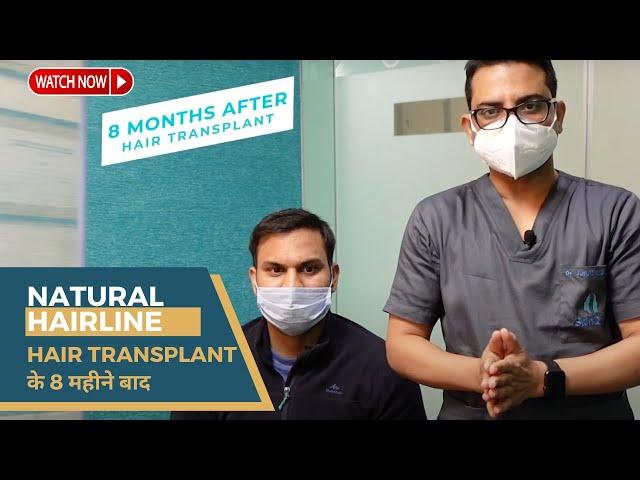 Natural Hairline with 2200 grafts | Hair Transplant Results 8 महीने बाद