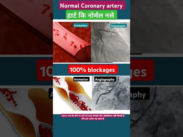 100% blockage Angiography me kaisa dikhta hai l #angiography #echo #shorts