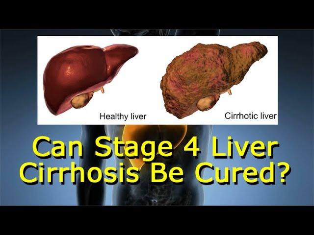 Can Stage 4 Liver Cirrhosis Be Cured?