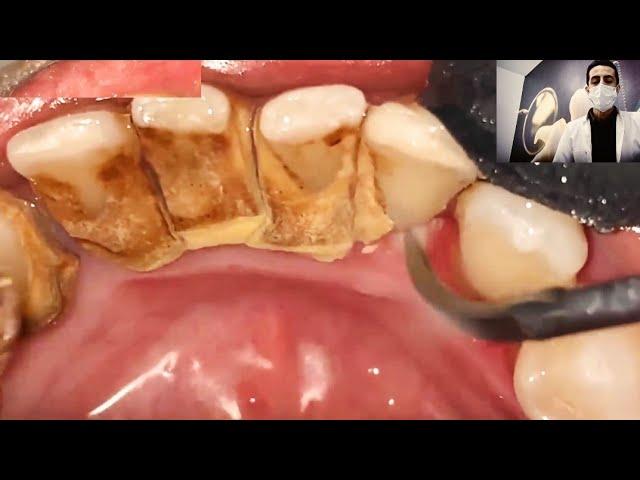 Teeth cleaning tartar removal from teeth